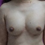 Breast Augmentation Before & After Patient #2967