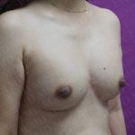 Breast Augmentation Before & After Patient #2967