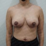 Breast Reduction Before & After Patient #2880