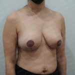 Breast Reduction Before & After Patient #2880