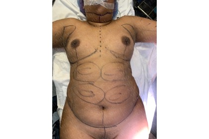 Liposuction Before & After Patient #2762