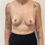 Breast Lift Before & After Patient #2802