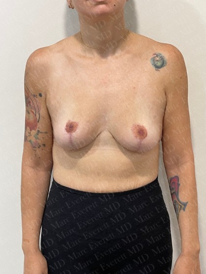 Breast Lift Before & After Patient #2802