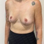 Breast Lift Before & After Patient #2802