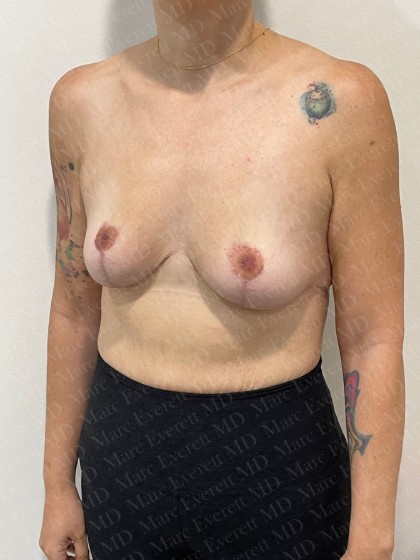 Breast Lift Before & After Patient #2802