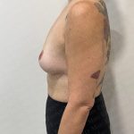 Breast Lift Before & After Patient #2802