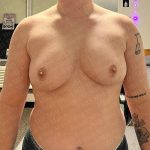 Chest Masculinization Surgery Before & After Patient #3147