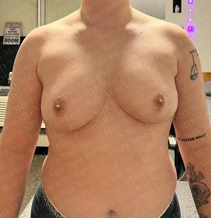 Chest Masculinization Surgery Before & After Patient #3147