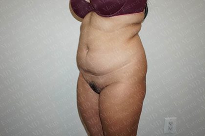 Liposuction Before & After Patient #3099