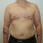 Chest Masculinization Surgery Before & After Patient #3146