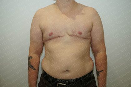 Chest Masculinization Surgery Before & After Patient #3146