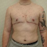 Chest Masculinization Surgery Before & After Patient #3147