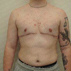 Chest Masculinization Surgery Before & After Patient #3147