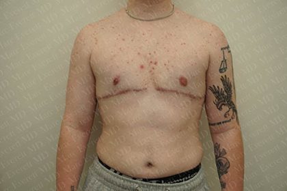 Chest Masculinization Surgery Before & After Patient #3147