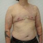 Chest Masculinization Surgery Before & After Patient #3146