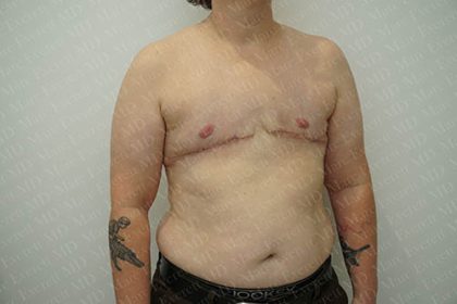 Chest Masculinization Surgery Before & After Patient #3146