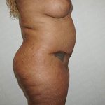 Liposuction Before & After Patient #3100