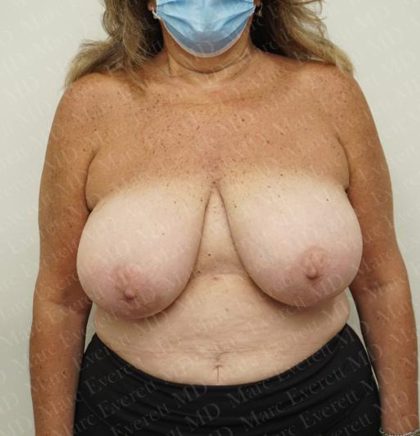 Breast Reduction Before & After Patient #2213