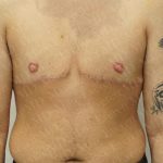 Chest Masculinization Surgery Before & After Patient #3259