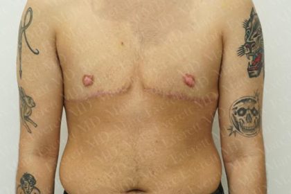 Chest Masculinization Surgery Before & After Patient #3259