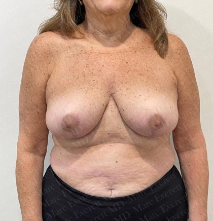 Breast Reduction Before & After Patient #2213