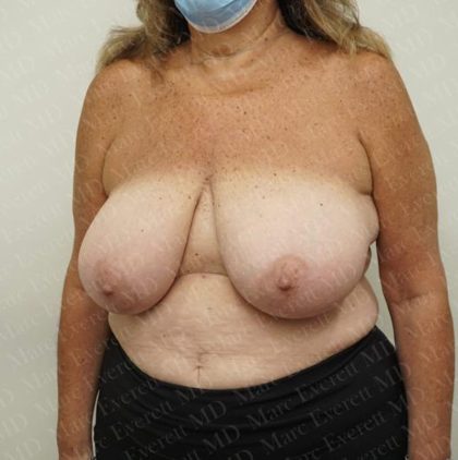 Breast Reduction Before & After Patient #2213