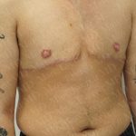 Chest Masculinization Surgery Before & After Patient #3259