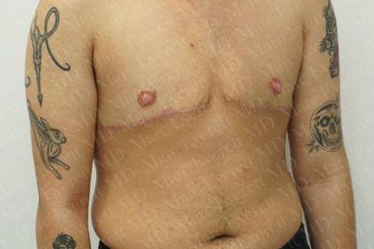 Chest Masculinization Surgery Before & After Patient #3259