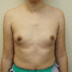 Breast Augmentation Before & After Patient #3223