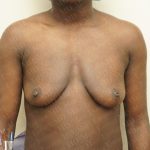 Chest Masculinization Surgery Before & After Patient #3231