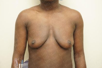 Chest Masculinization Surgery Before & After Patient #3231