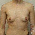 Chest Masculinization Surgery Before & After Patient #3237