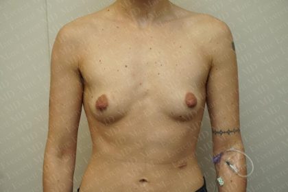 Chest Masculinization Surgery Before & After Patient #3237