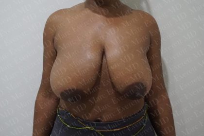 Breast Reduction Before & After Patient #2376