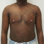 Chest Masculinization Surgery Before & After Patient #3231