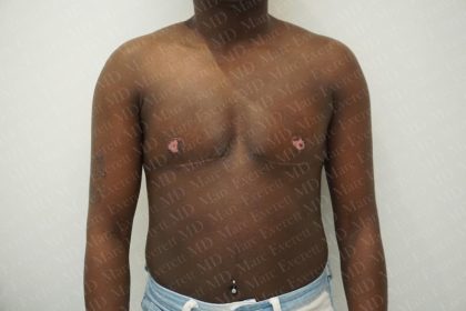 Chest Masculinization Surgery Before & After Patient #3231