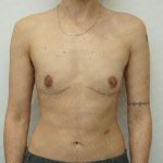 Chest Masculinization Surgery Before & After Patient #3237