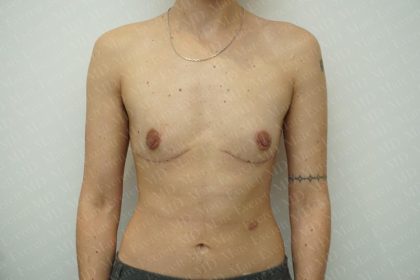 Chest Masculinization Surgery Before & After Patient #3237