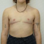 Chest Masculinization Surgery Before & After Patient #3244