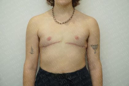 Chest Masculinization Surgery Before & After Patient #3244