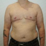 Chest Masculinization Surgery Before & After Patient #3251
