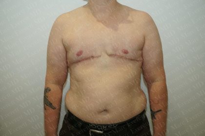 Chest Masculinization Surgery Before & After Patient #3251