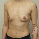 Chest Masculinization Surgery Before & After Patient #3237