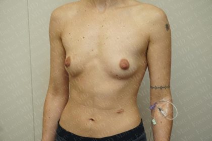 Chest Masculinization Surgery Before & After Patient #3237