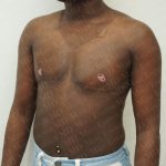 Chest Masculinization Surgery Before & After Patient #3231