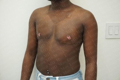 Chest Masculinization Surgery Before & After Patient #3231