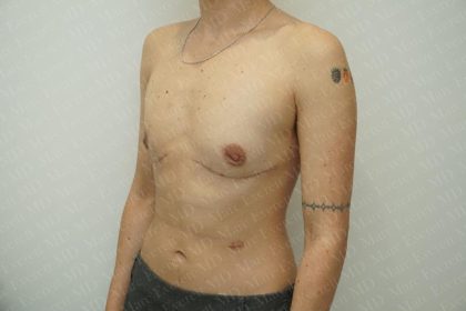 Chest Masculinization Surgery Before & After Patient #3237