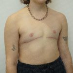 Chest Masculinization Surgery Before & After Patient #3244