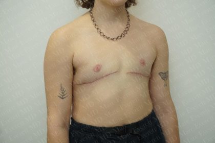 Chest Masculinization Surgery Before & After Patient #3244