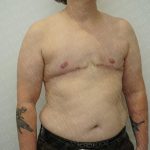 Chest Masculinization Surgery Before & After Patient #3251